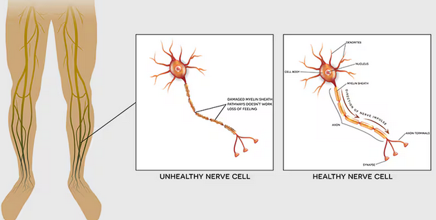الأسباب الشائعة لتنميل الرجل